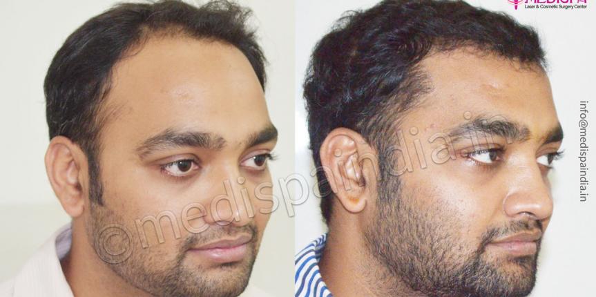 kolkata hair transplant cost