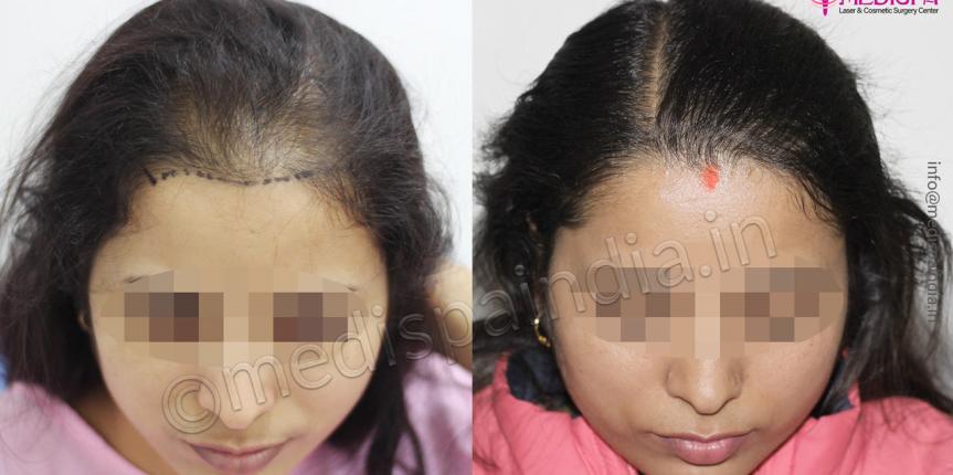 female hair transplant results delhi