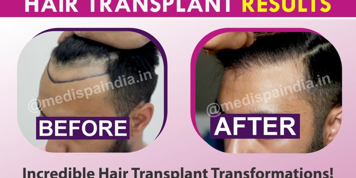 Is It Possible To Get Hair Transplantation Without Scars?