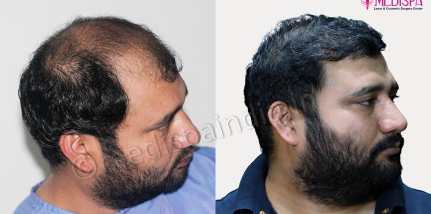 top hair restoration india result in rajasthan