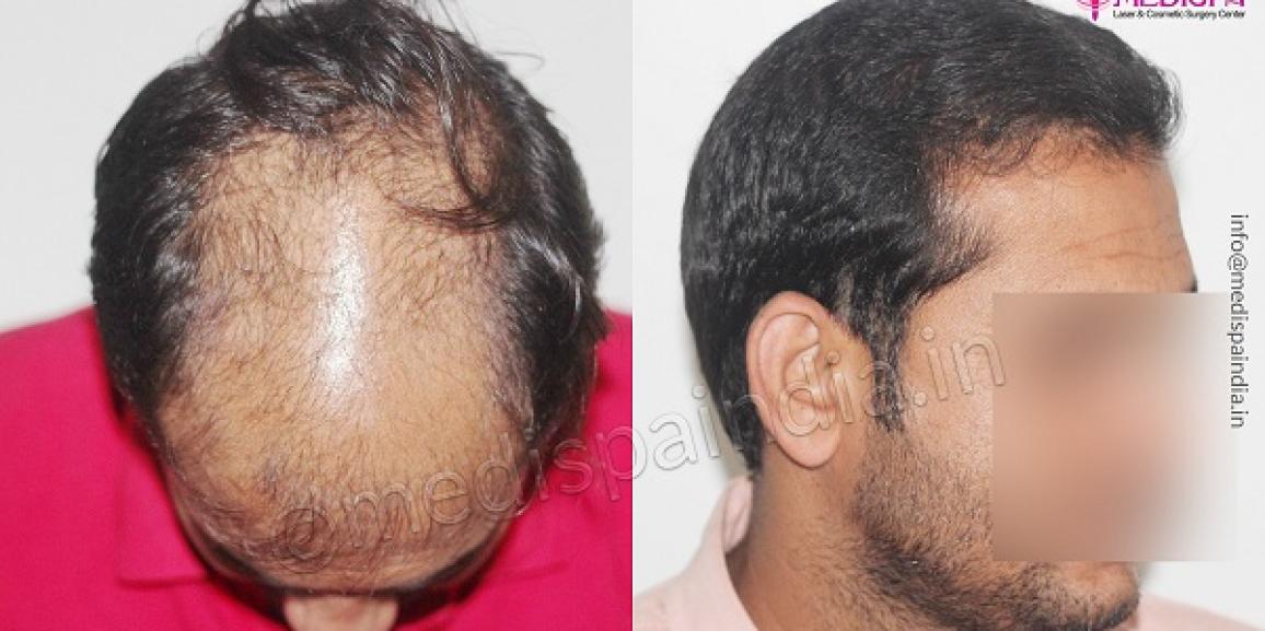 How To Find The Best Surgeon For Hair Transplant in South Delhi?