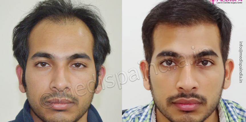 hair transplant in haryana