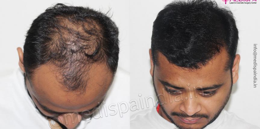 best hair transplant before after results