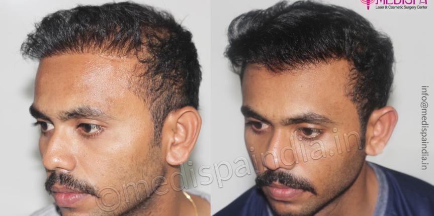 india wrong hair transplant correction