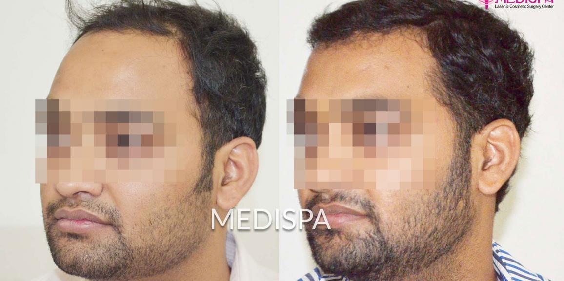 The Combined Technique of FUT+FUE Hair Transplant with PRP