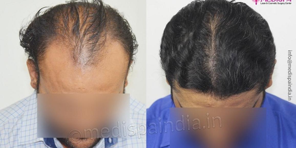 Why Is Hair Transplant Better Than Other Hair Loss Treatments?