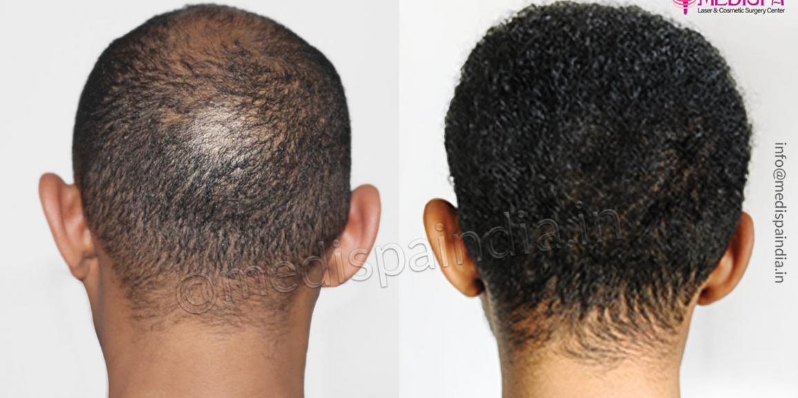 5 Reasons Why You Should Consider Hair Transplant For Hair Loss?