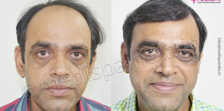 hair transplant in kota