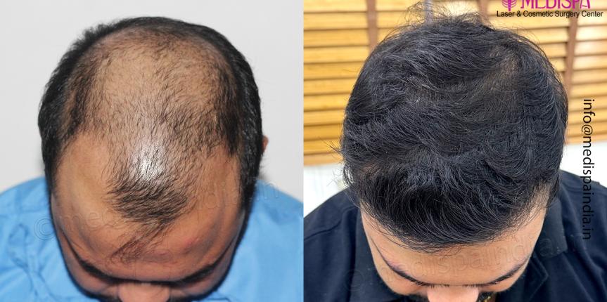 Hair Restoration Results Delhi