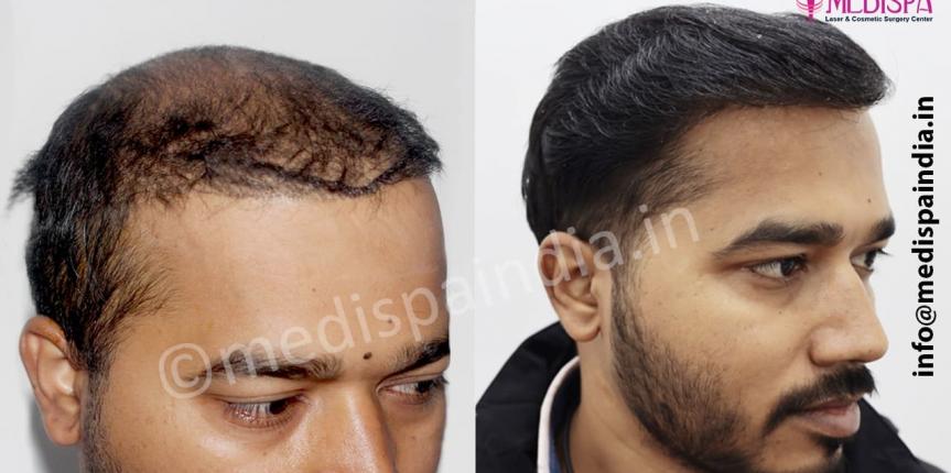 wrong hair transplant repair in jaipur