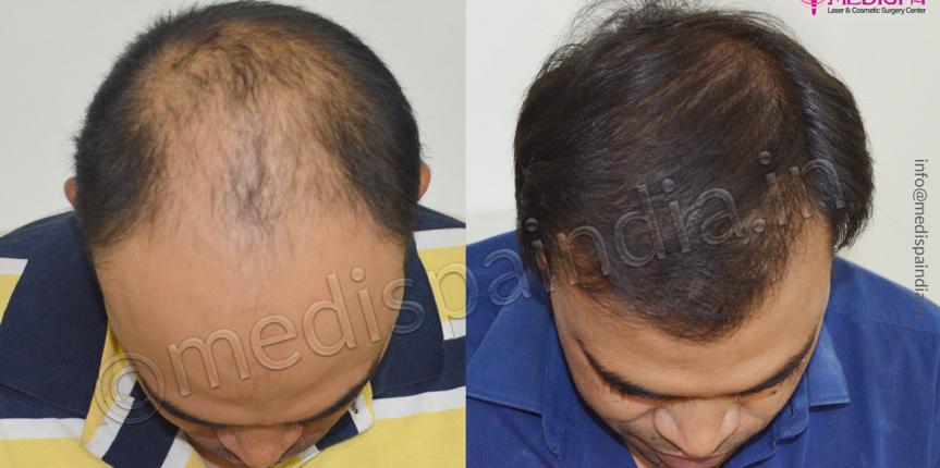 top hair transplant surgeons in jaipur india