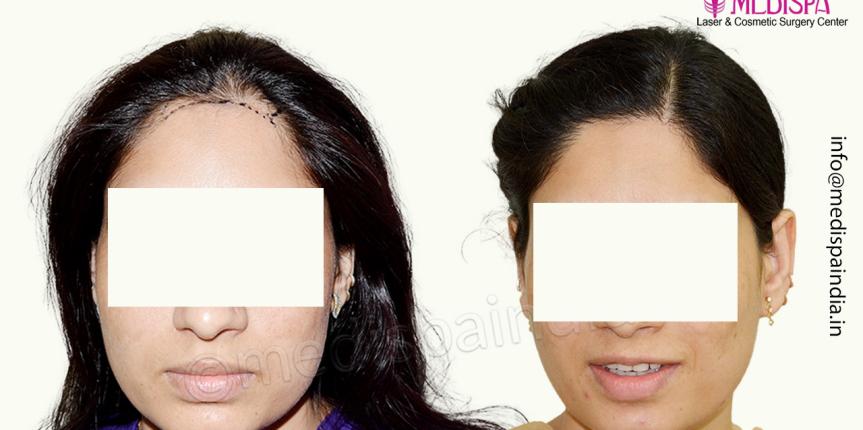 female hair transplant