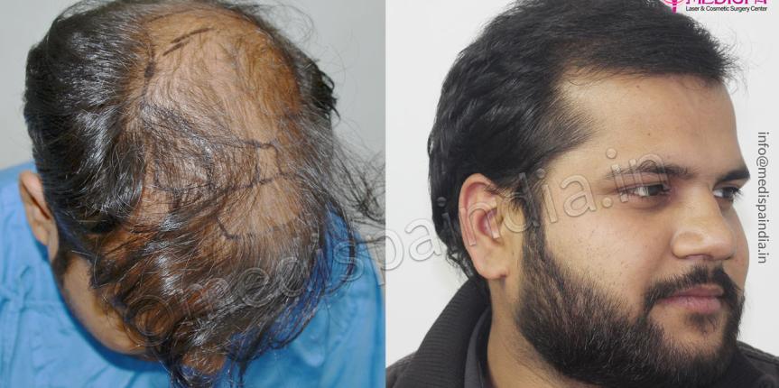 hair transplant jaipur cost india