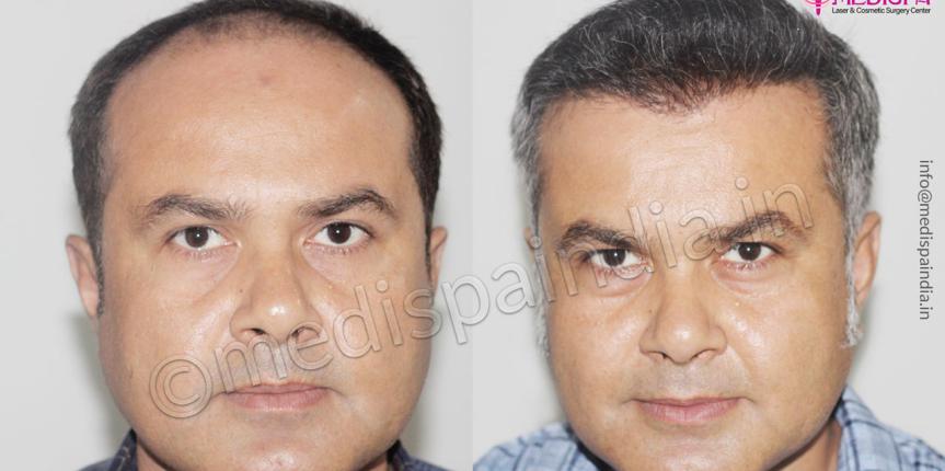 hair transplant dubai results