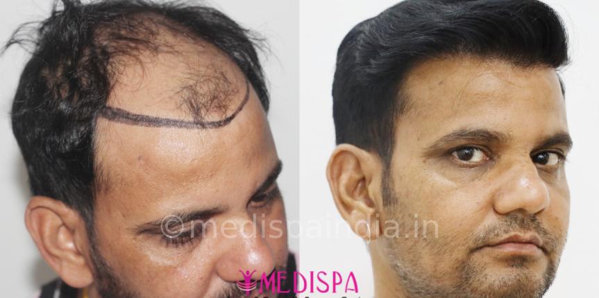 india hair transplant cost