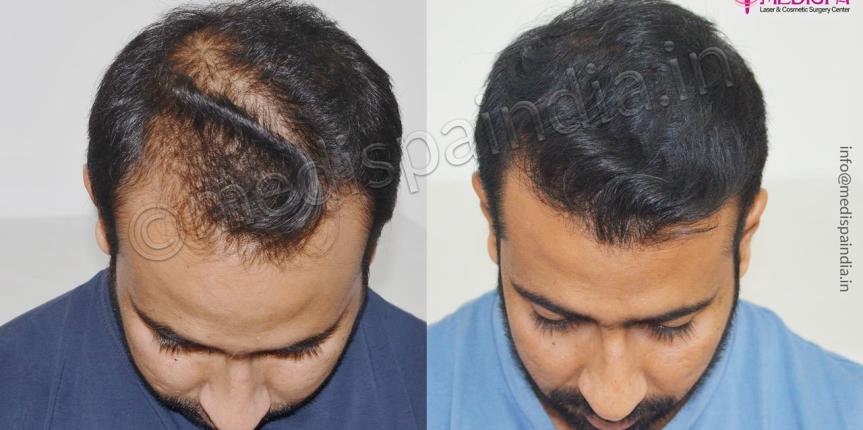 best hair transplant surgeons in hyderabad