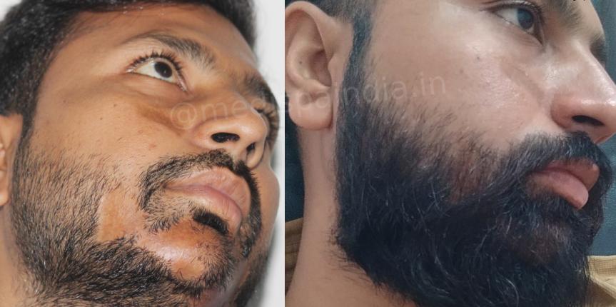 beard hair transplant jaipur