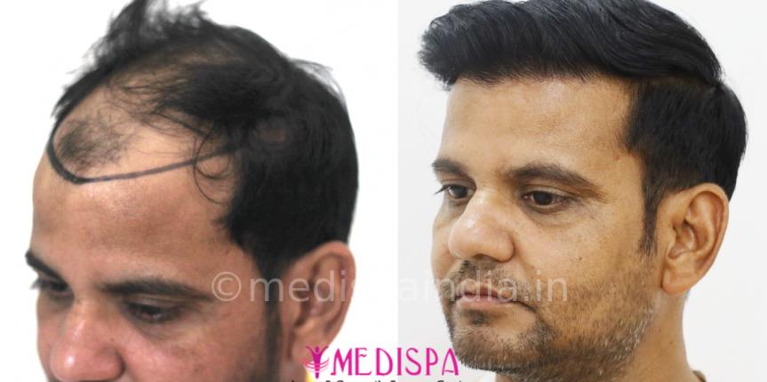 best hair transplant results