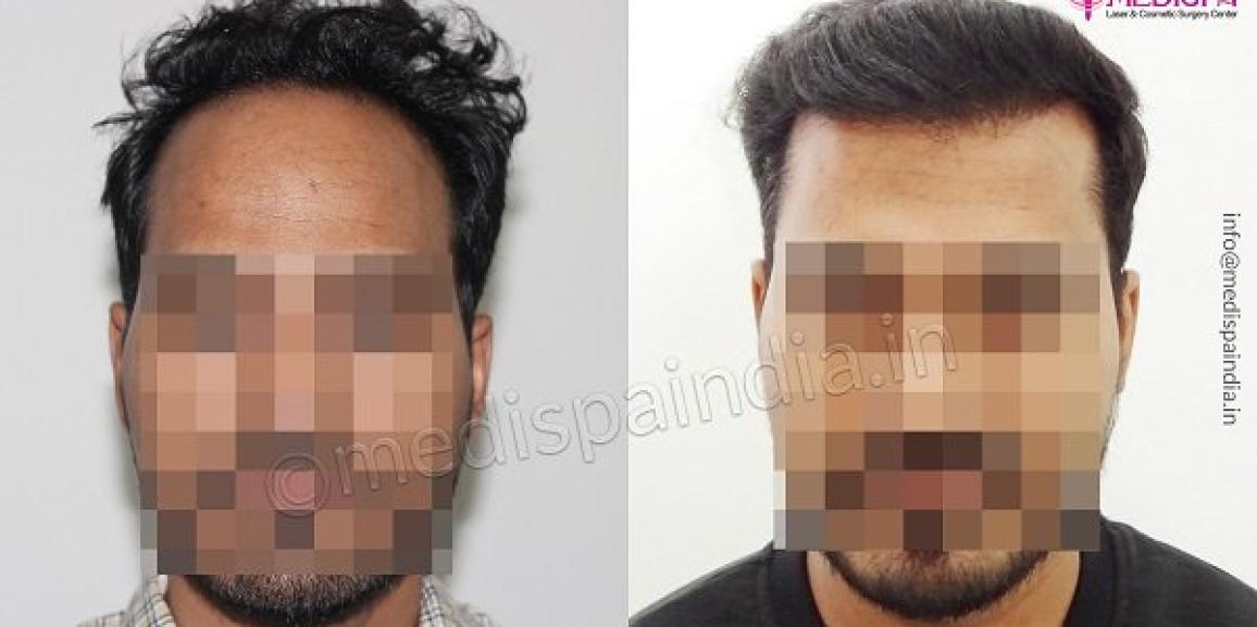 How To Get Natural Hairline And Growth By Hair Transplant?