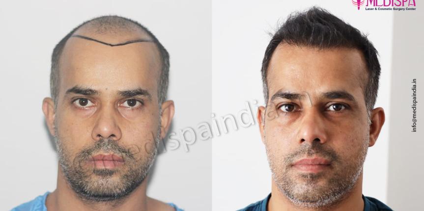 hair restoration results india