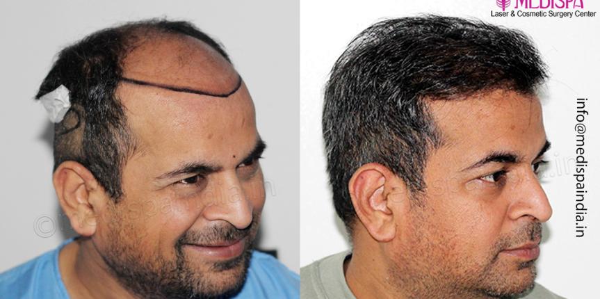 best hair transplant center results bangalore