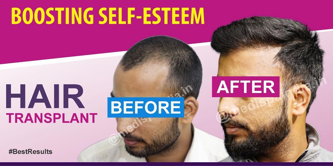 Are There Any Risks Involved With Hair Transplant Surgery?