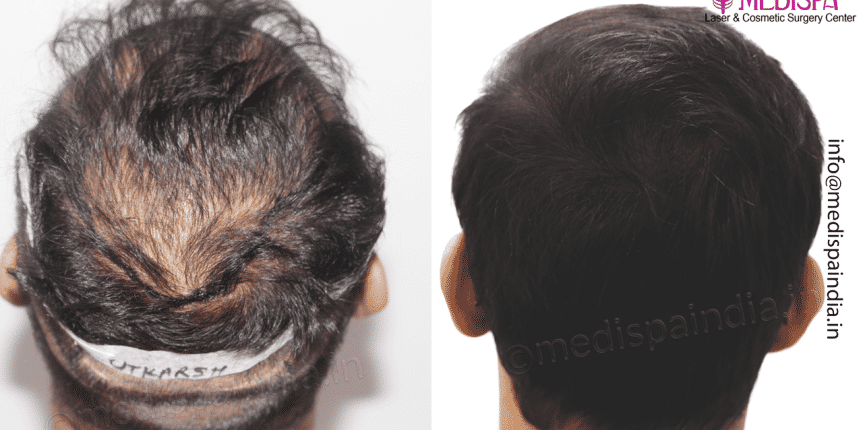 best hair restoration delhi