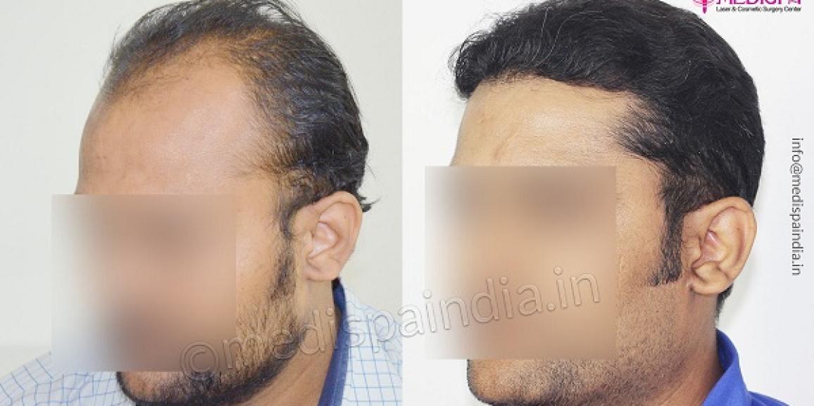 Recovering From Hair Transplant Surgery: What To Expect?