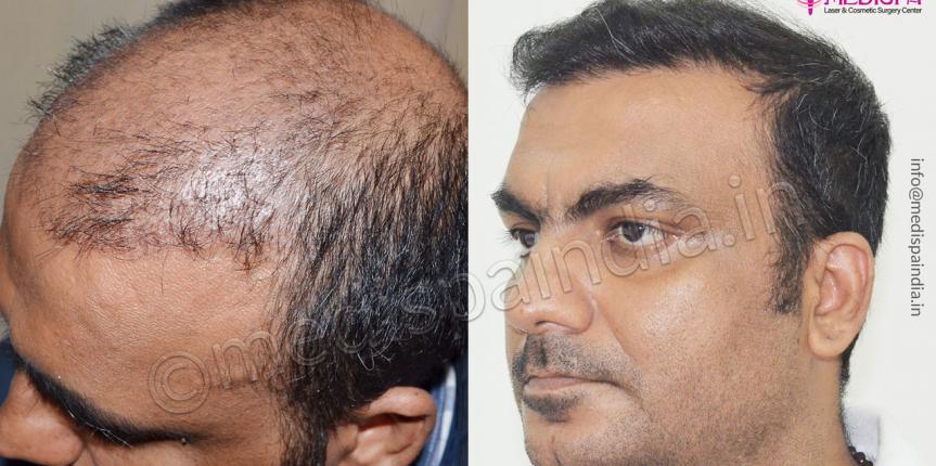 hair transplant in bikaner