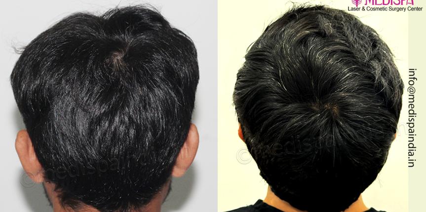 Fue hair transplant result