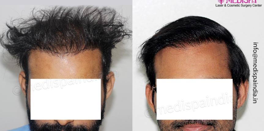 wrong hair transplant repair india