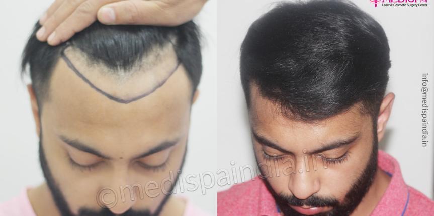 cost of hair transplant india
