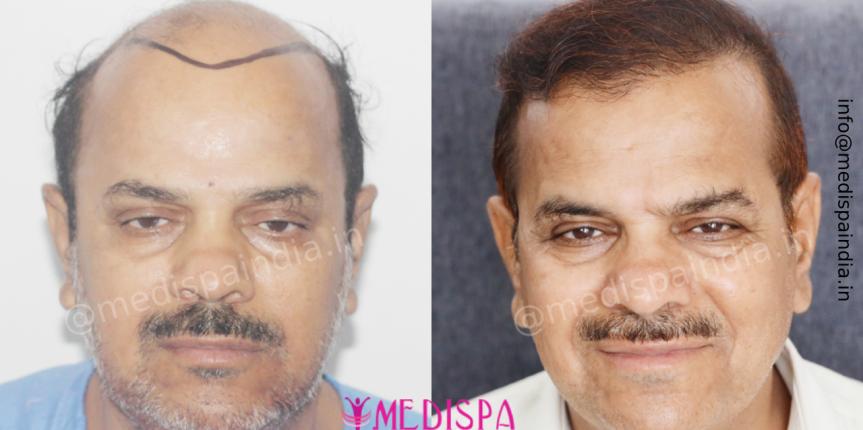hair transplant surgeonindia