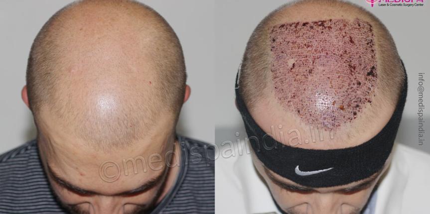 hair transplant results australian