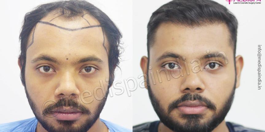 fue hair transplant results