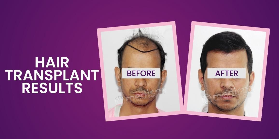 Revitalize Your Hairline: Everything to know about Hair Transplant