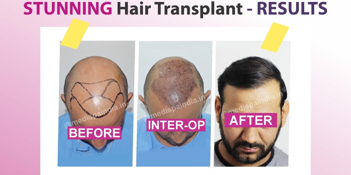 Regain Your Personality With Hair Transplant For High Grade Baldness