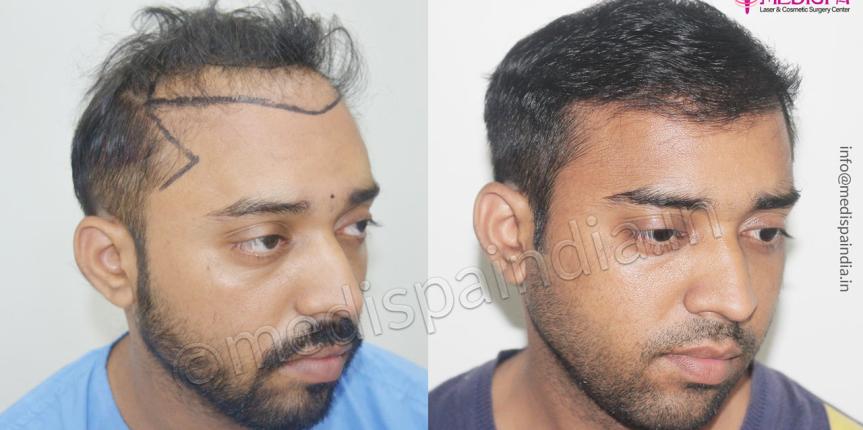 wrong hair transplant correction in jaipur