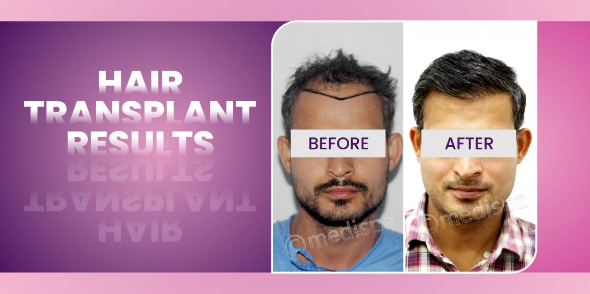 Is Hair Restoration Suitable For You? Points To Consider Before Making The Decision