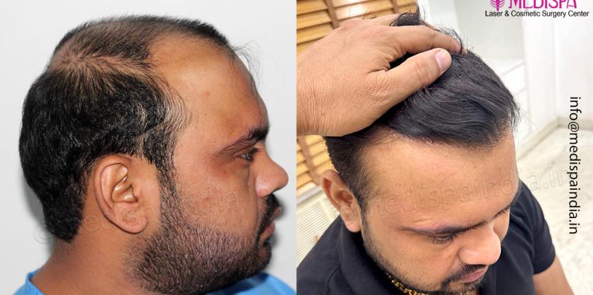 hair restoration faridabad
