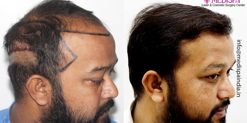 hair restoration results gurgaon