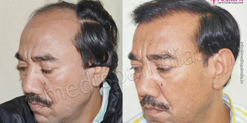 hair transplant in JK