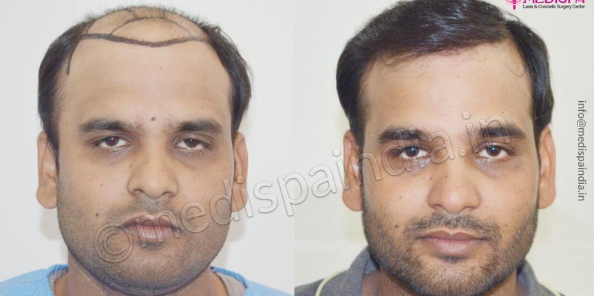 hair transplant in ahmedabad