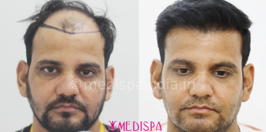 hair transplant in jaipur