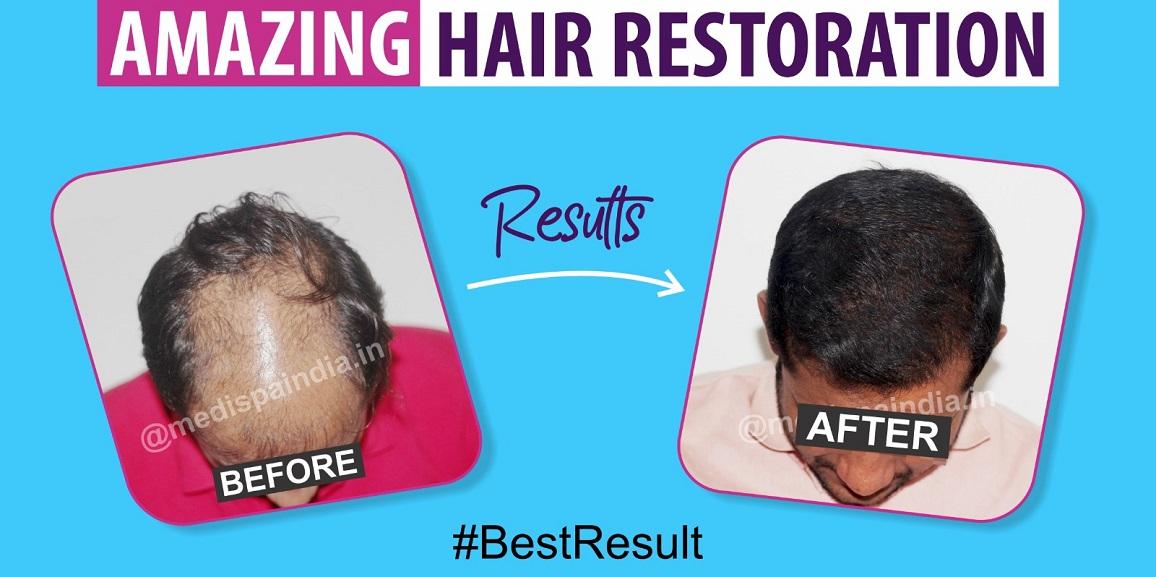 Restore Your Crown: Say Goodbye To High Grade Baldness With Hair Transplant