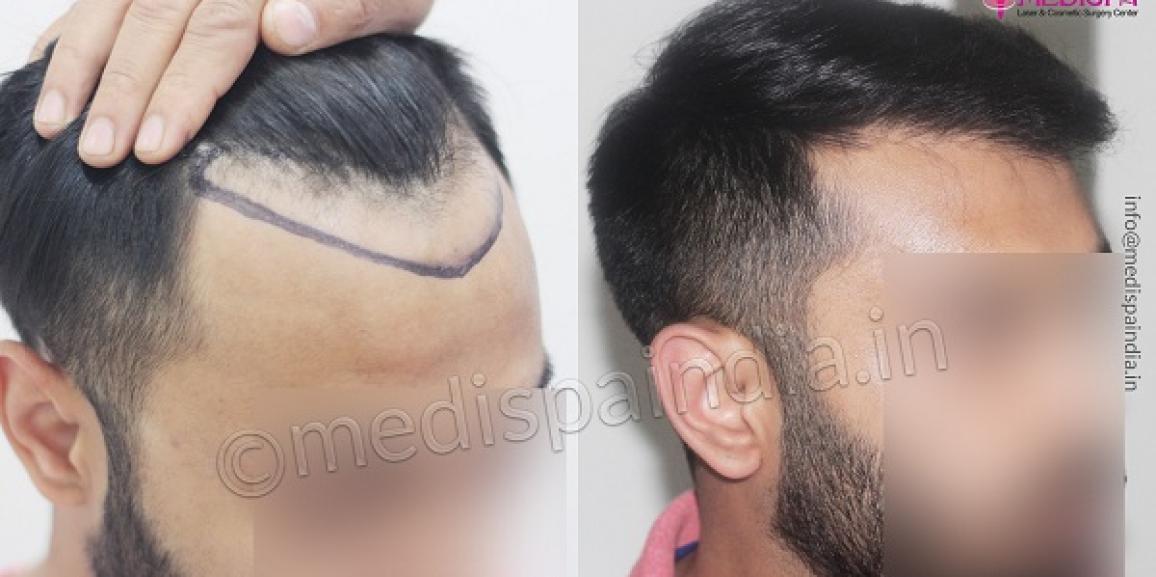 What Causes The Issue Of Hair Loss And How Can Hair Transplant Help?