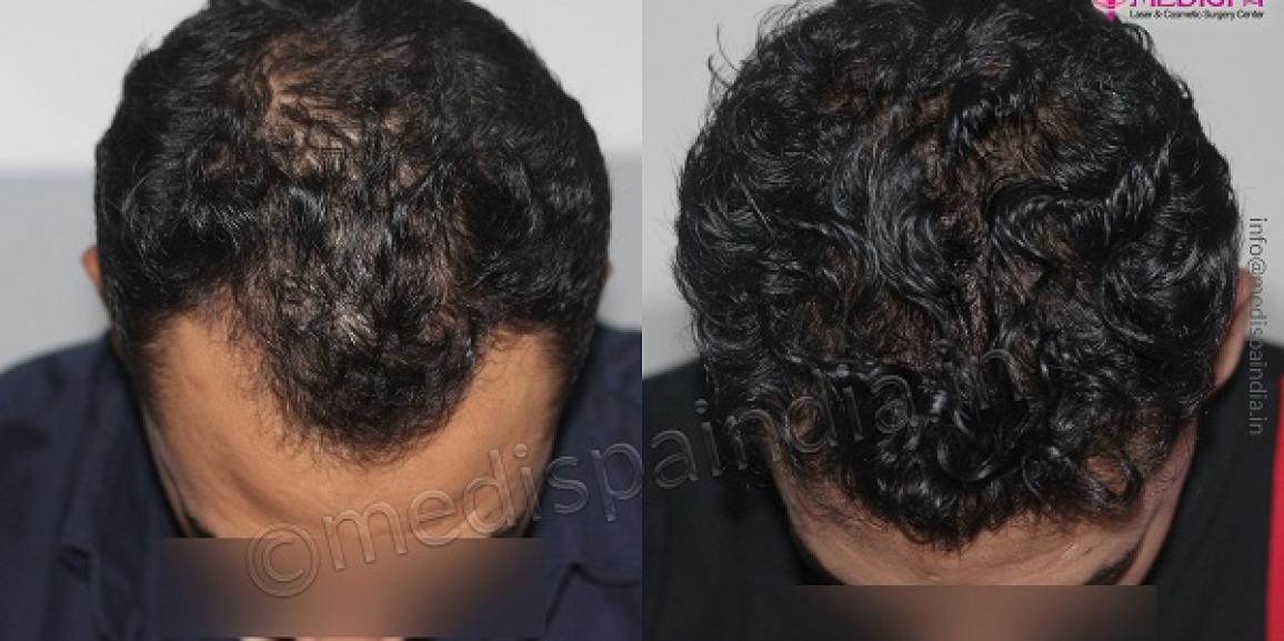 How To Get Rid of Pattern Baldness By Hair Transplantation?