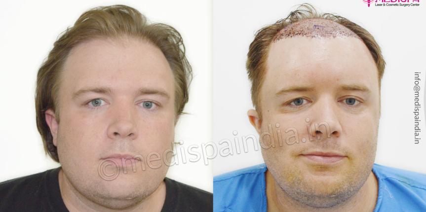 hair transplant usa results