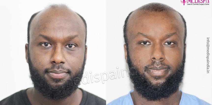 hair transplant sweden results