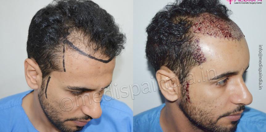 hair transplant dubai result